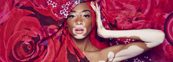 Лечение на Кубе: Витилиго, Псориаза, Алопеции